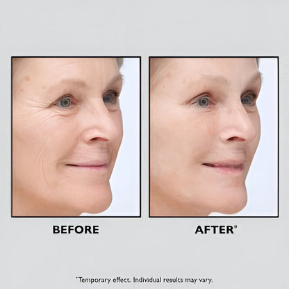 MyoTight™ - Temporary Face Tightener